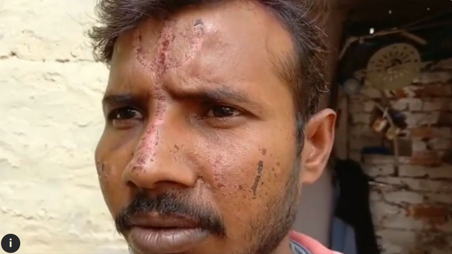 ಆ್ಯಸಿಡ್ ಬಳಸಿ ವ್ಯಕ್ತಿಯ ಹಣೆಯಲ್ಲಿ ತ್ರಿಶೂಲ ಬಿಡಿಸಿದ ಕಿಡಿಗೇಡಿಗಳು: ಇದು ಹೋಳಿ ಬಣ್ಣದ ಅಡ್ಡಪರಿಣಾಮ ಎಂದ ಪೊಲೀಸರು !