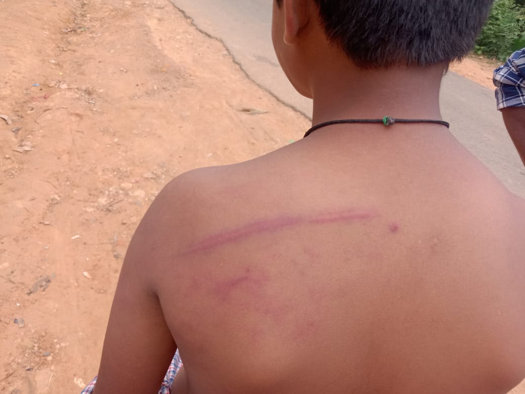 ಕೊಪ್ಪ | ತಲೆನೋವು ಎಂದಿದ್ದಕ್ಕೆ 6ನೇ ತರಗತಿ ವಿದ್ಯಾರ್ಥಿಗೆ ಬಾಸುಂಡೆ ಬರುವಂತೆ ಶಿಕ್ಷಕನಿಂದ ಹಲ್ಲೆ