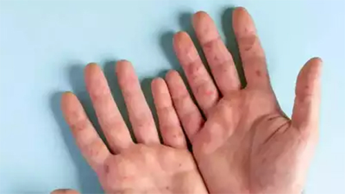 ಕೇರಳ ಬಳಿಕ, ಹರ್ಯಾಣ, ತಮಿಳುನಾಡು, ಒಡಿಶಾದಲ್ಲೂ ಟೊಮ್ಯಾಟೊ ಜ್ವರ