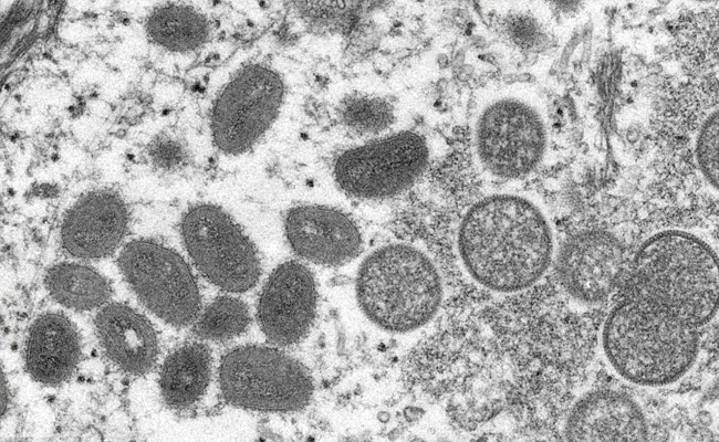 ವ್ಯಕ್ತಿಯೋರ್ವನಿಗೆ ಏಕಕಾಲದಲ್ಲಿ ಕೋವಿಡ್, ಮಂಕಿಪಾಕ್ಸ್ ಎಚ್ಐವಿ ಸೋಂಕು ದೃಢ ! ವ್ಯಕ್ತಿಯೋರ್ವನಿಗೆ ಏಕಕಾಲದಲ್ಲಿ ಕೋವಿಡ್, ಮಂಕಿಪಾಕ್ಸ್ ಎಚ್ಐವಿ ಸೋಂಕು ದೃಢ !