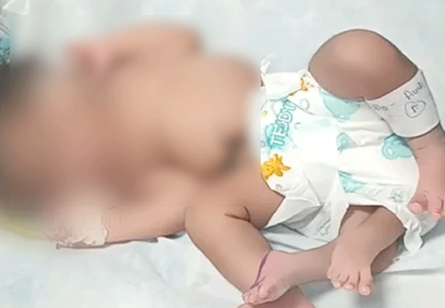 ಮಧ್ಯಪ್ರದೇಶ: ನಾಲ್ಕು ಕಾಲಿರುವ ಮಗುವಿಗೆ ಜನ್ಮ ನೀಡಿದ ತಾಯಿ