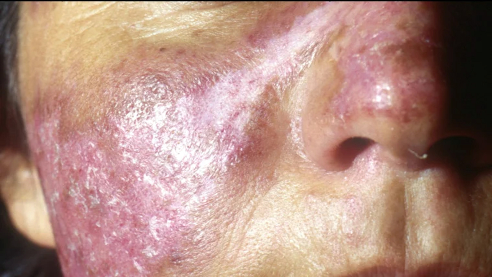 ದೇಹದ ಅಂಗಾಂಗಗಳನ್ನು ಕಾಡುವ ಲೂಪಸ್ ರೋಗ