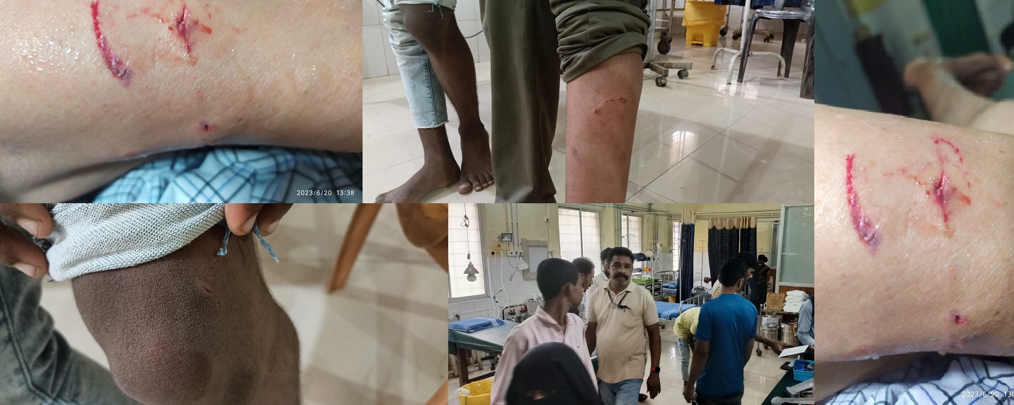 ಭಟ್ಕಳ: ಹತ್ತು ಮಂದಿಯ ಮೇಲೆ ಬೀದಿ ನಾಯಿ ದಾಳಿ